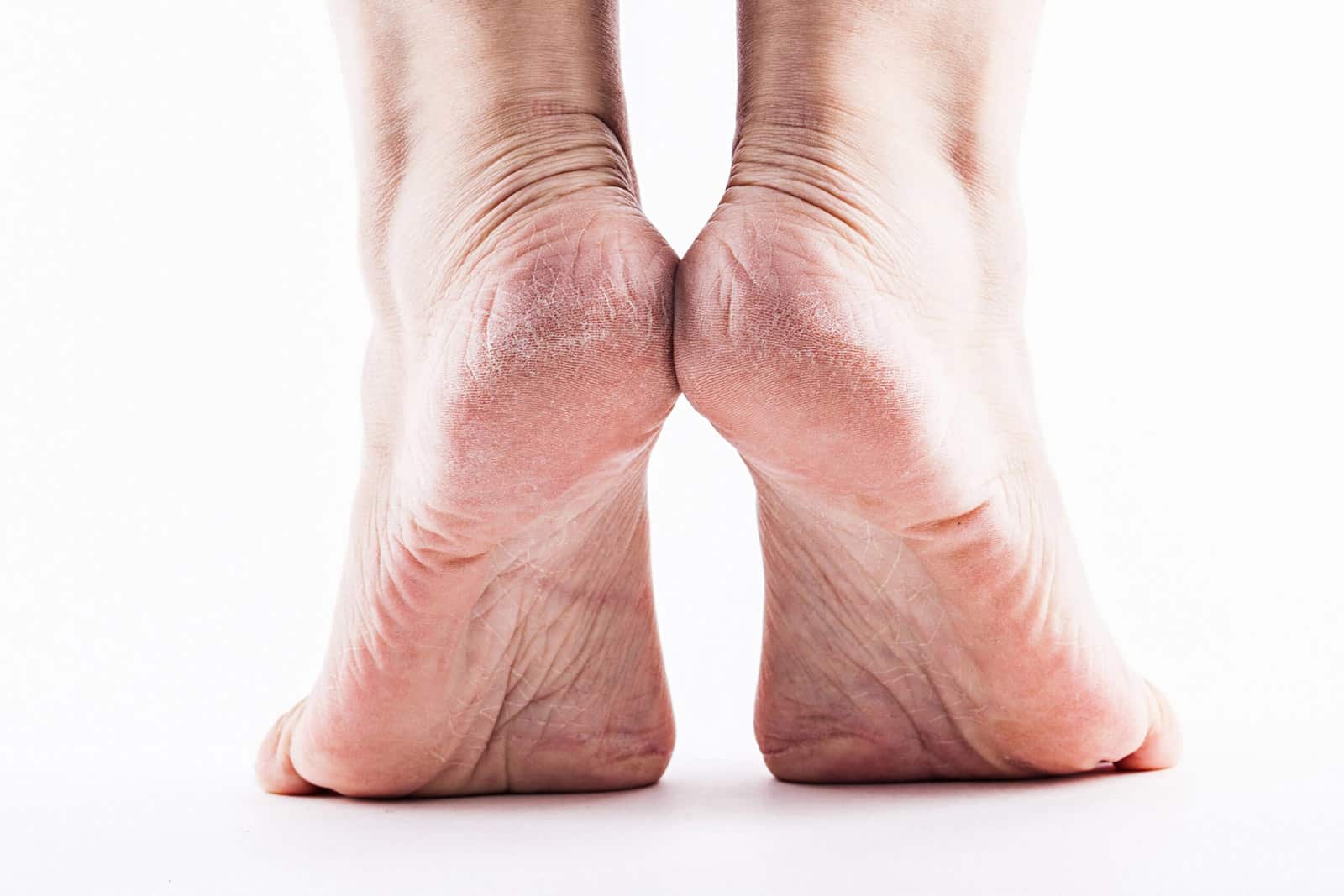dry skin feet